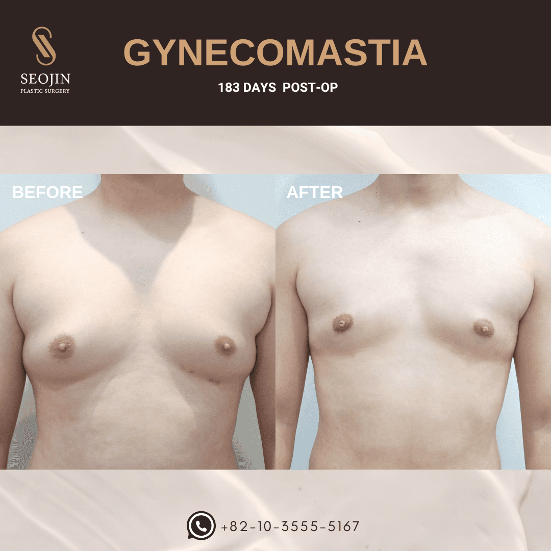 gynecomastia korea