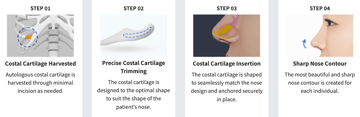 Rhinoplastik