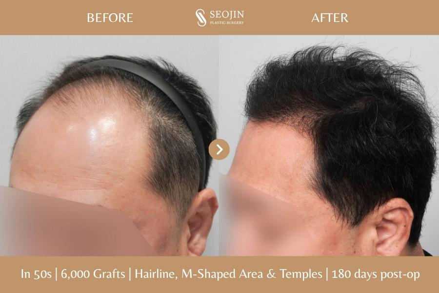 Seojin Plastic Surgery Clinic before and after image