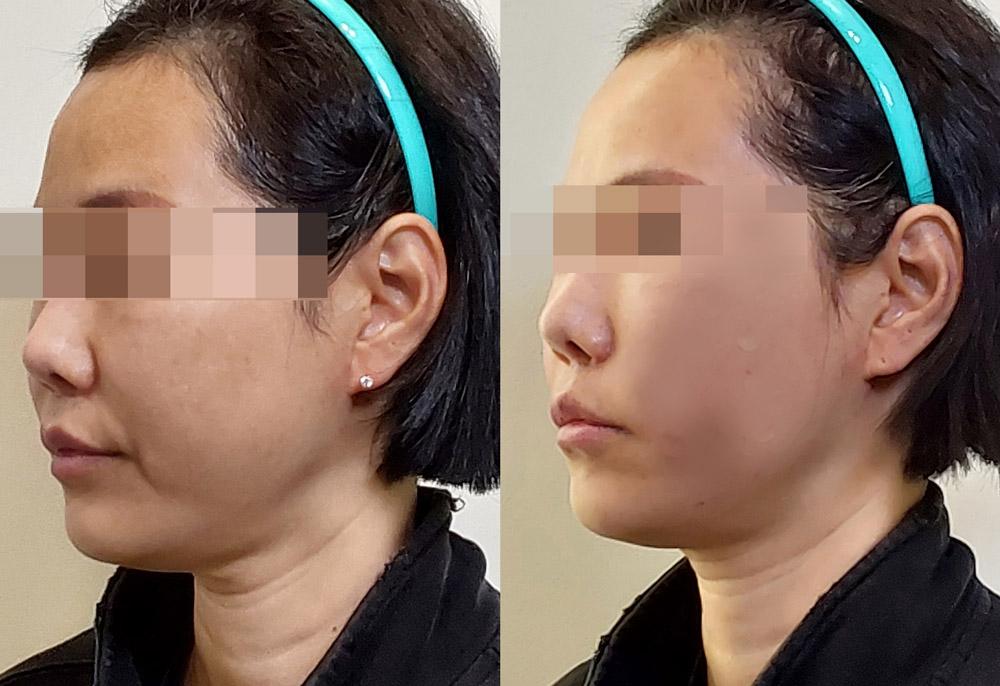 Before and After Face Thread Lift