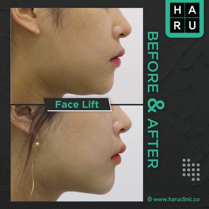 🤷‍♀️🤷‍♀️A facelift, or rhytidectomy, is a surgical procedure to improve visible signs of aging in the face. For an amazing face lift service there are a great reputation in Haru clinic.   Take an appointment today for Face lift services.   🏥