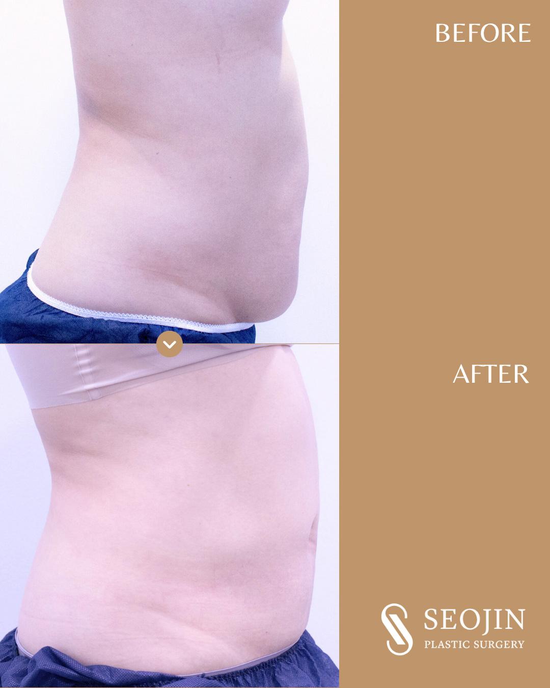 Abdominale Liposuktion