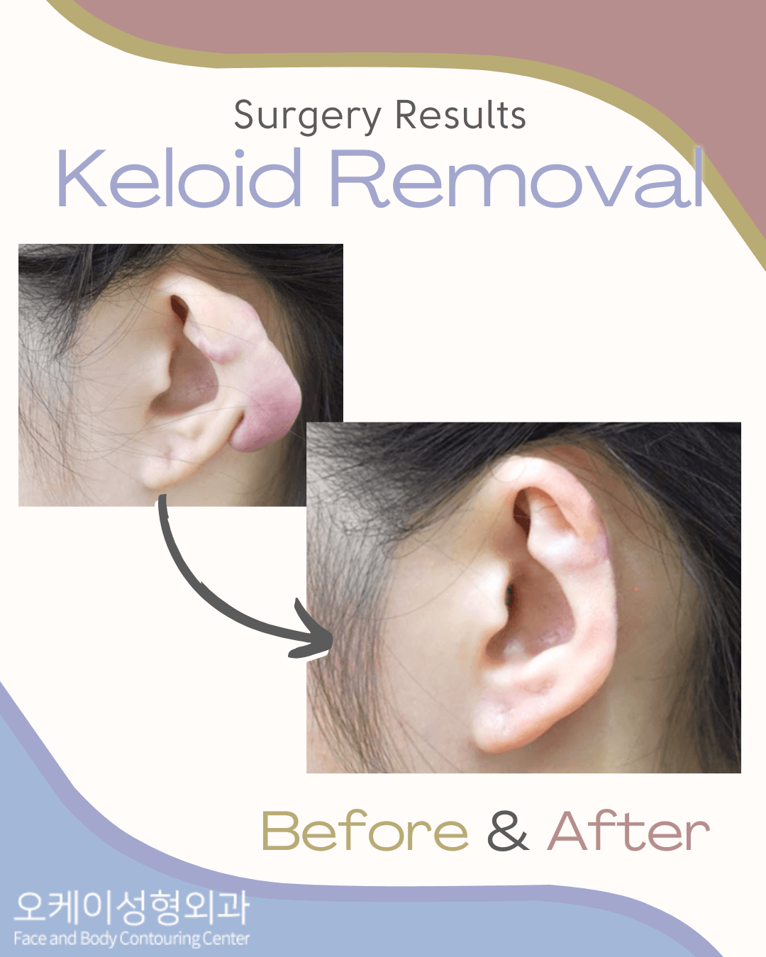 Okay Plastic Surgery Clinic before and after image