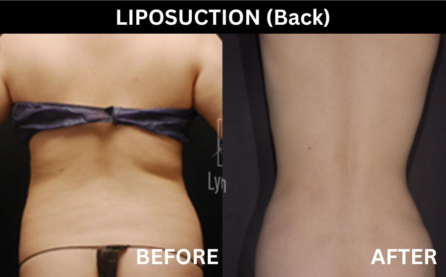 cost back liposuction korea