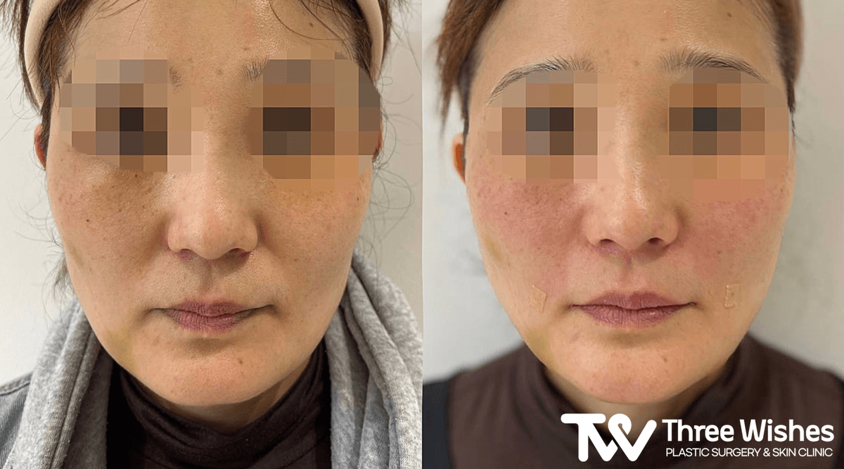 Before and After Smile Line Filler