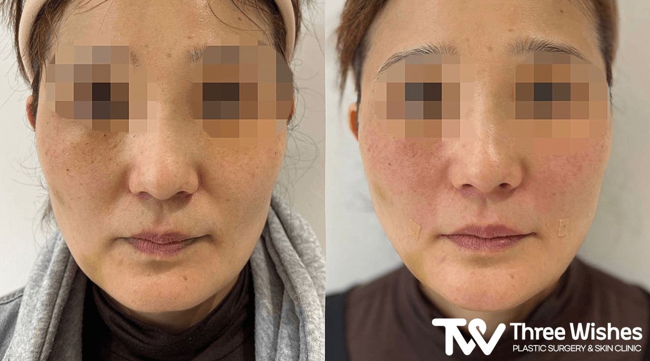 Before and After Smile Line Filler