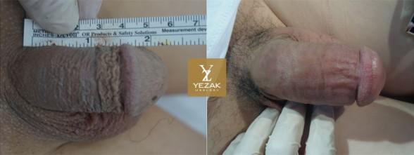 Before and After Glans Enlargement
