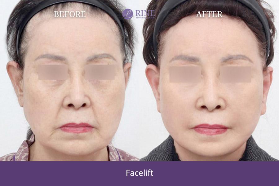 SMAS Facelift
