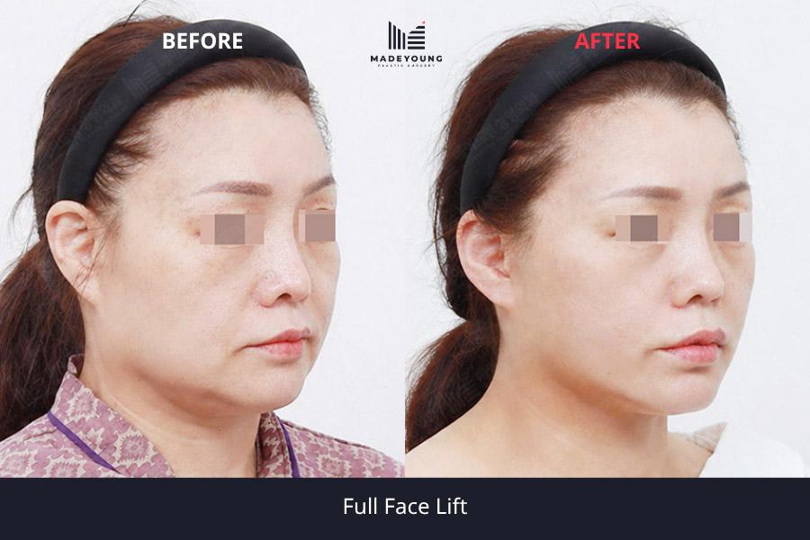 Face lift