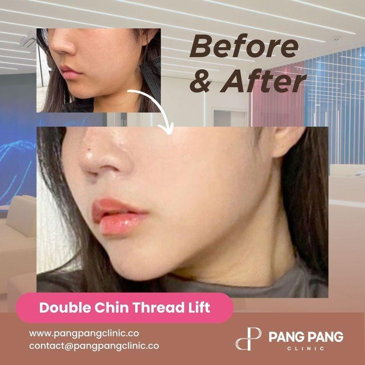 Double Chin Thread Lift: Say Goodbye to Your Double Chin, Naturally! 👋  If you're bothered by the appearance of a double chin, you're not alone. Many people struggle with this common problem. But the good news is that there's a safe and effective way to get rid of it without surgery: a double chin thread lift.  A double chin thread lift is a minimally invasive procedure that uses small, dissolvable threads to lift and tighten the skin under your chin. The threads are inserted under the skin through tiny incisions, and then pulled tight to create a lifting effect. The procedure is typically performed in just 30-60 minutes, and most patients experience minimal downtime.