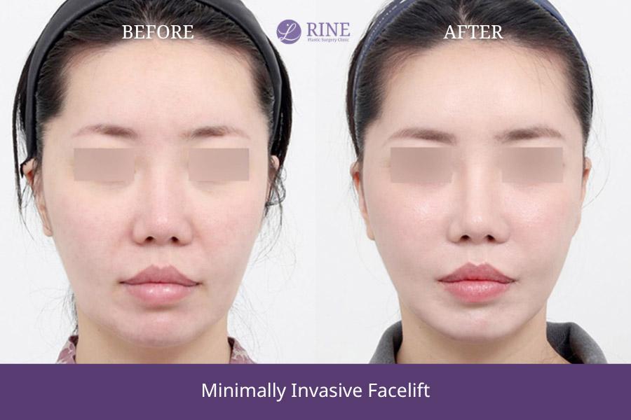 Minimally Invasive facelift