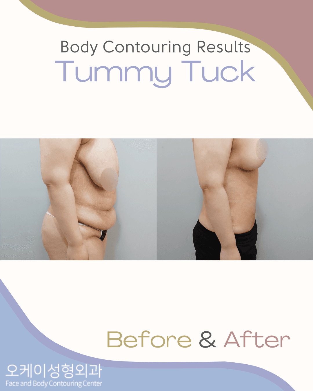 cost tummy tuck korea