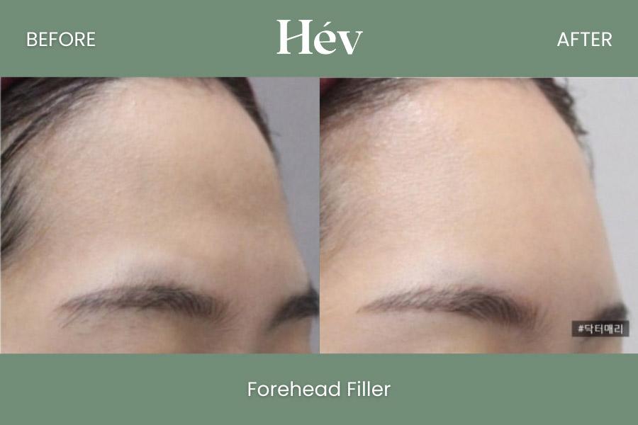 Before and After Forehead Filler