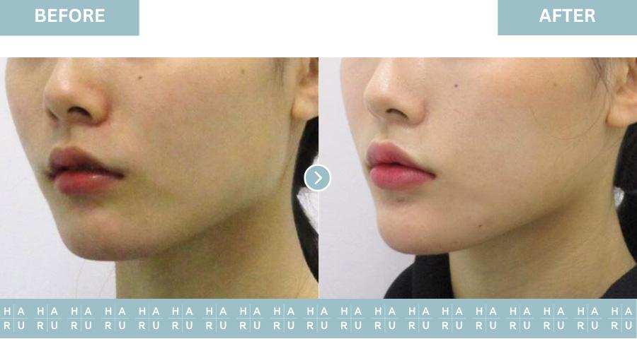 Before and After Chin Filler