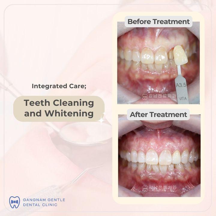 teeth cleaning korea