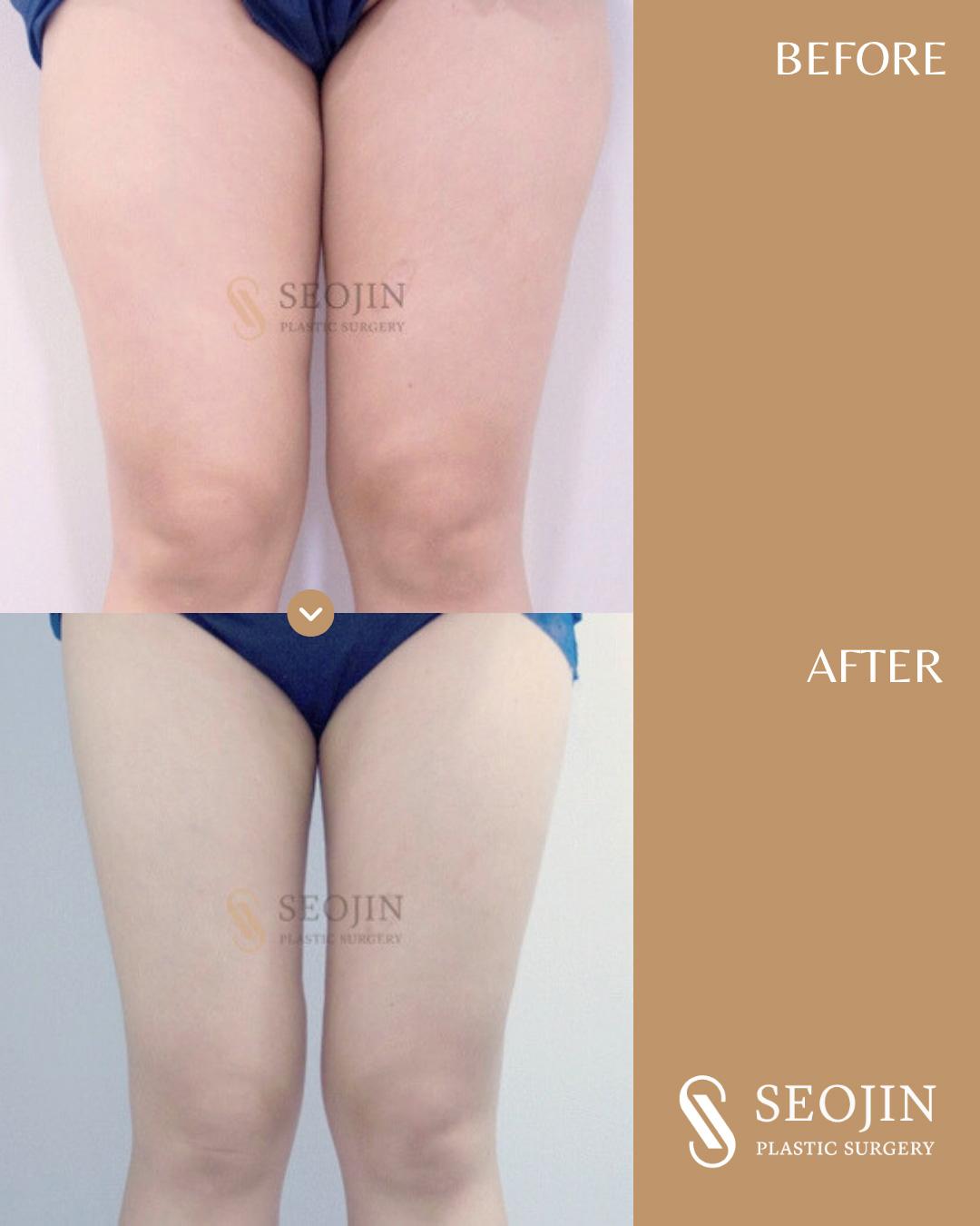 seojin-thigh-liposuction-1 