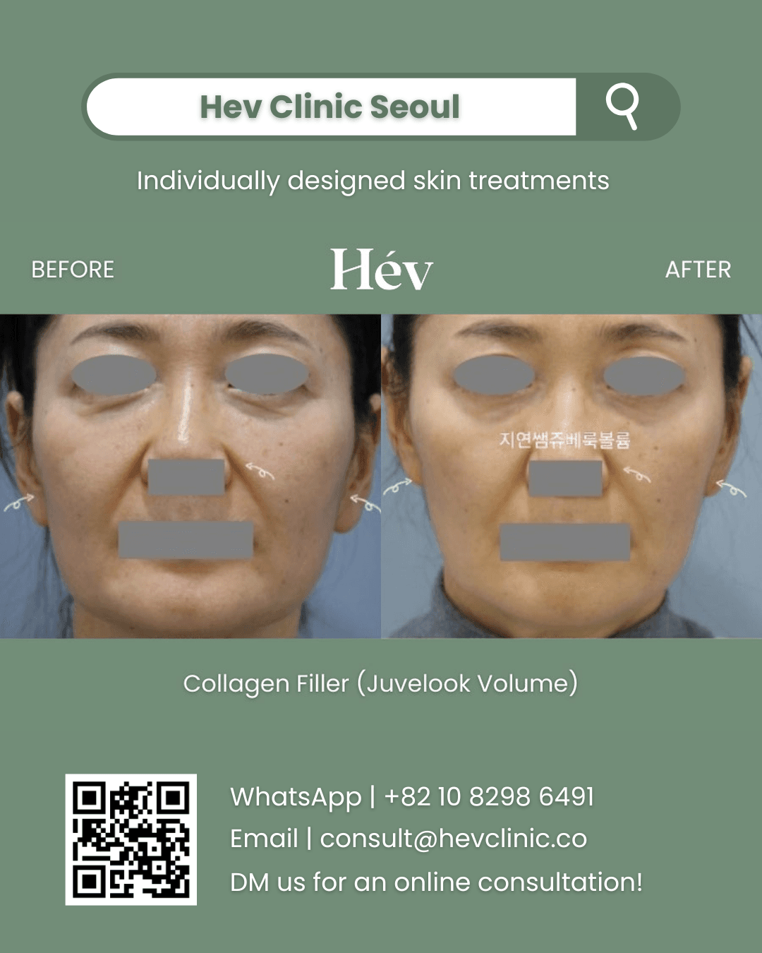 Juvelook Volume Filler
