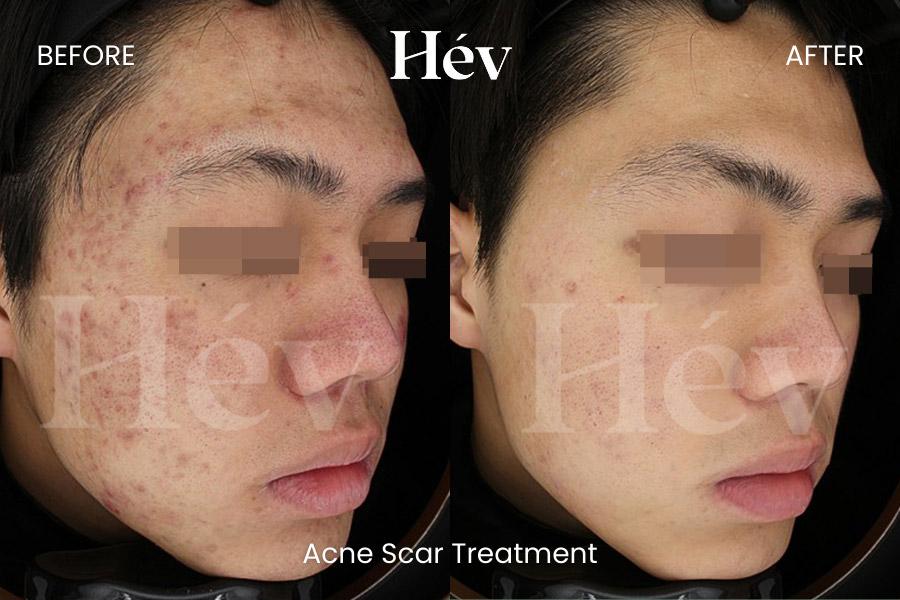 Before and After Acne Scar Treatment