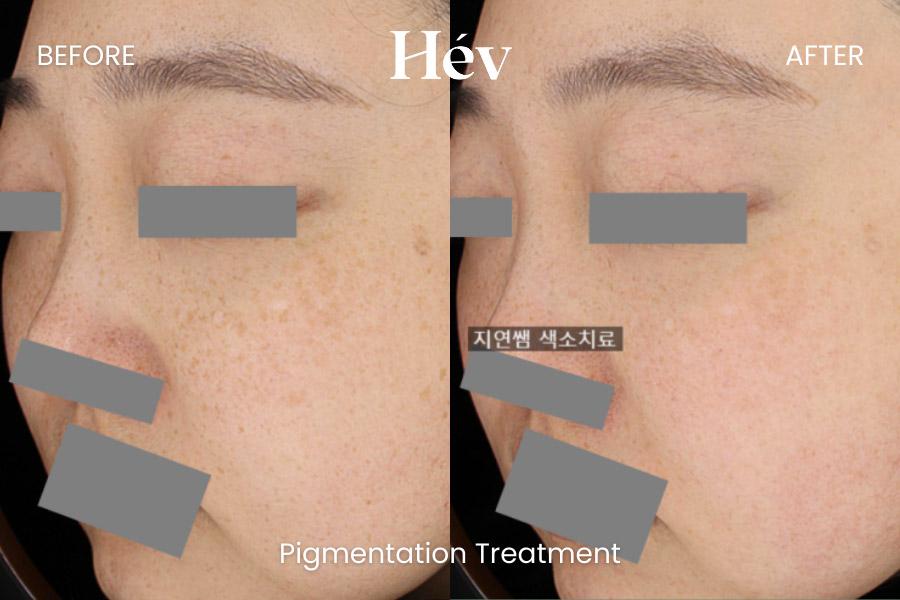 Before and After Pigmentation Treatment