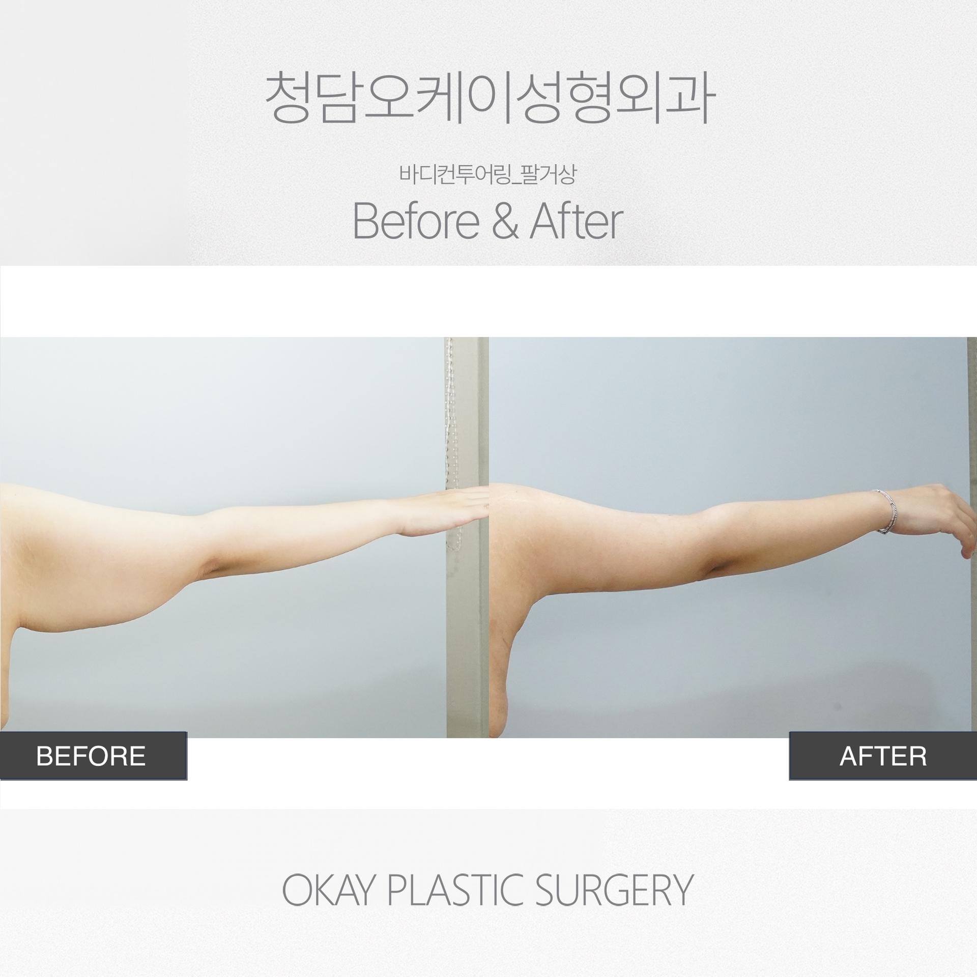 Okay Plastic Surgery Clinic before and after image