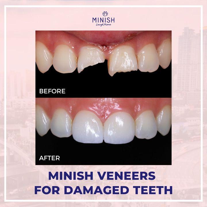 cost veneers korea