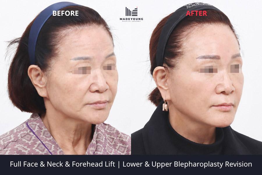 Face lift neck lift forehead lift lower blepharoplasty revision upper blepharoplasty revision