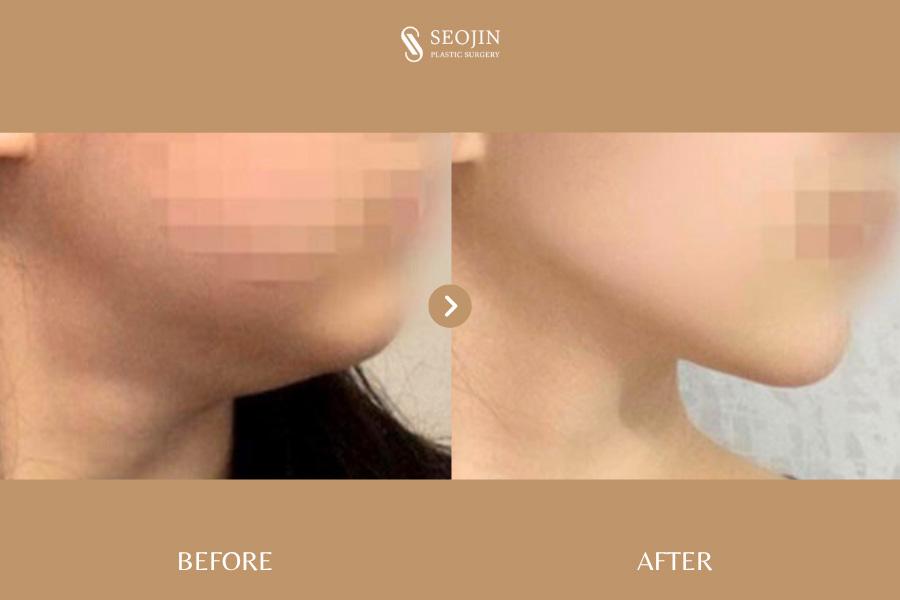 Vorher-Nachher-Bild der Seojin Plastic Surgery Clinic