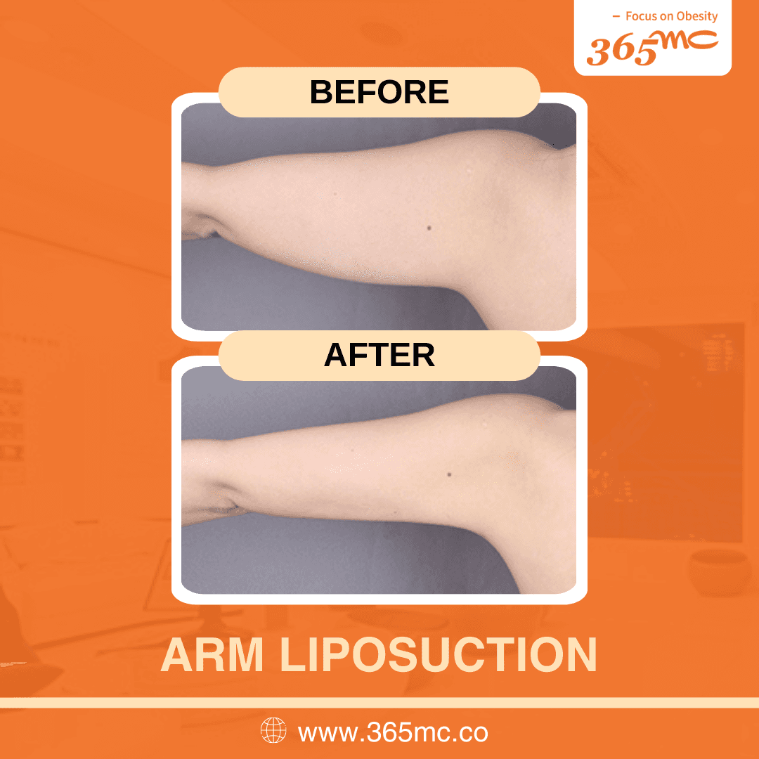 bna - arm iiposuction.png