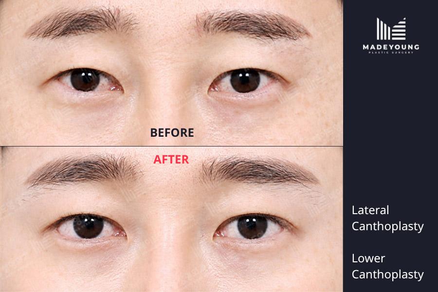 Before and After Canthoplasty