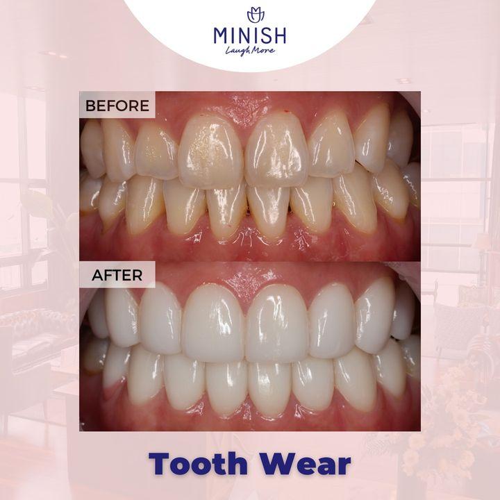 Tooth wear is when you lose a portion of your tooth’s surface. We will help to  relieve painful symptoms and restore your smile back to full health and beauty through Minish Veneers in order to rebuild the missing tooth structure and eroded enamel.