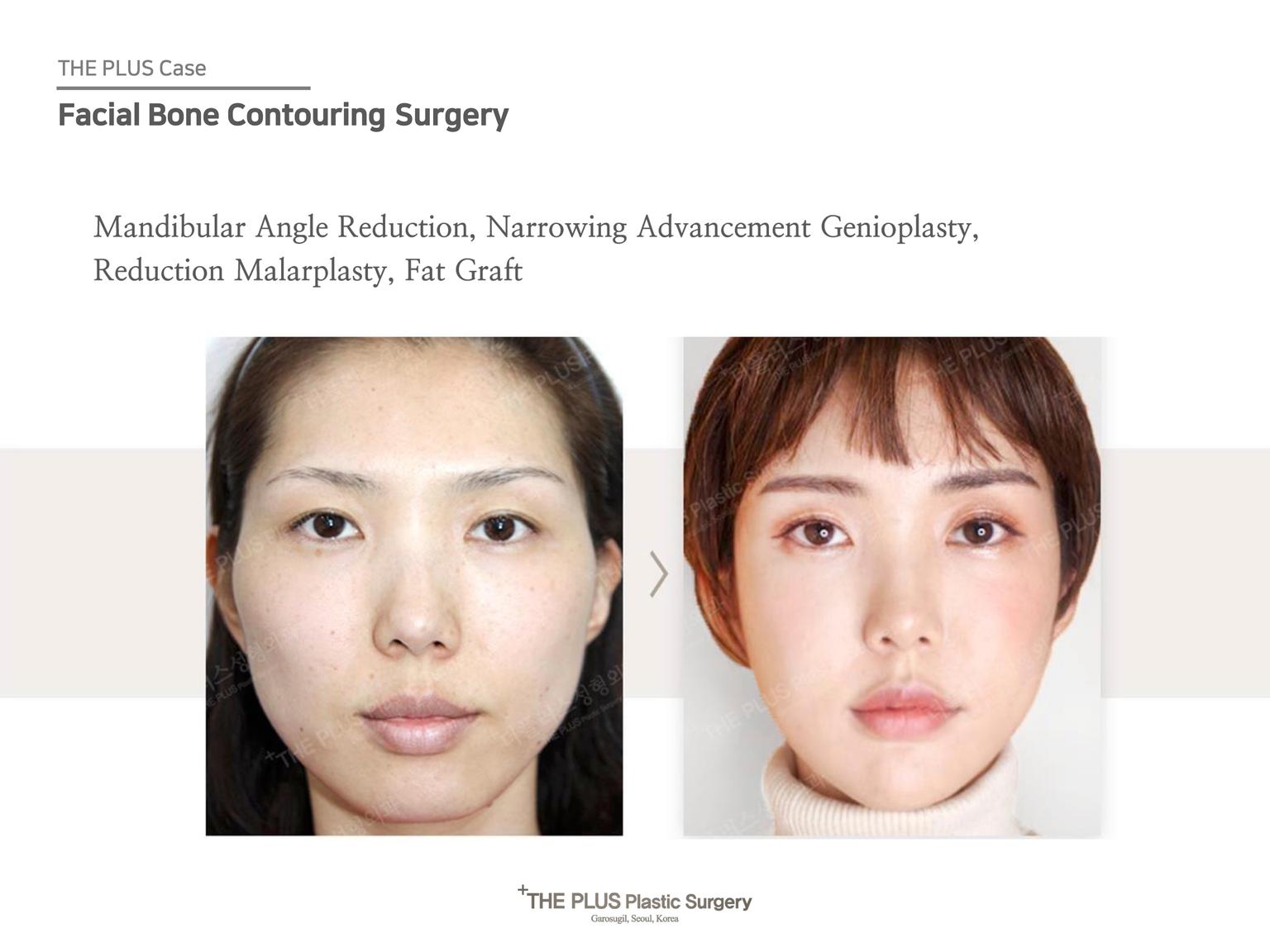 Mandibular Angle Reduction & Narrowing Advancement Genioplasty & Reduction Malarplasty & Fat Graft