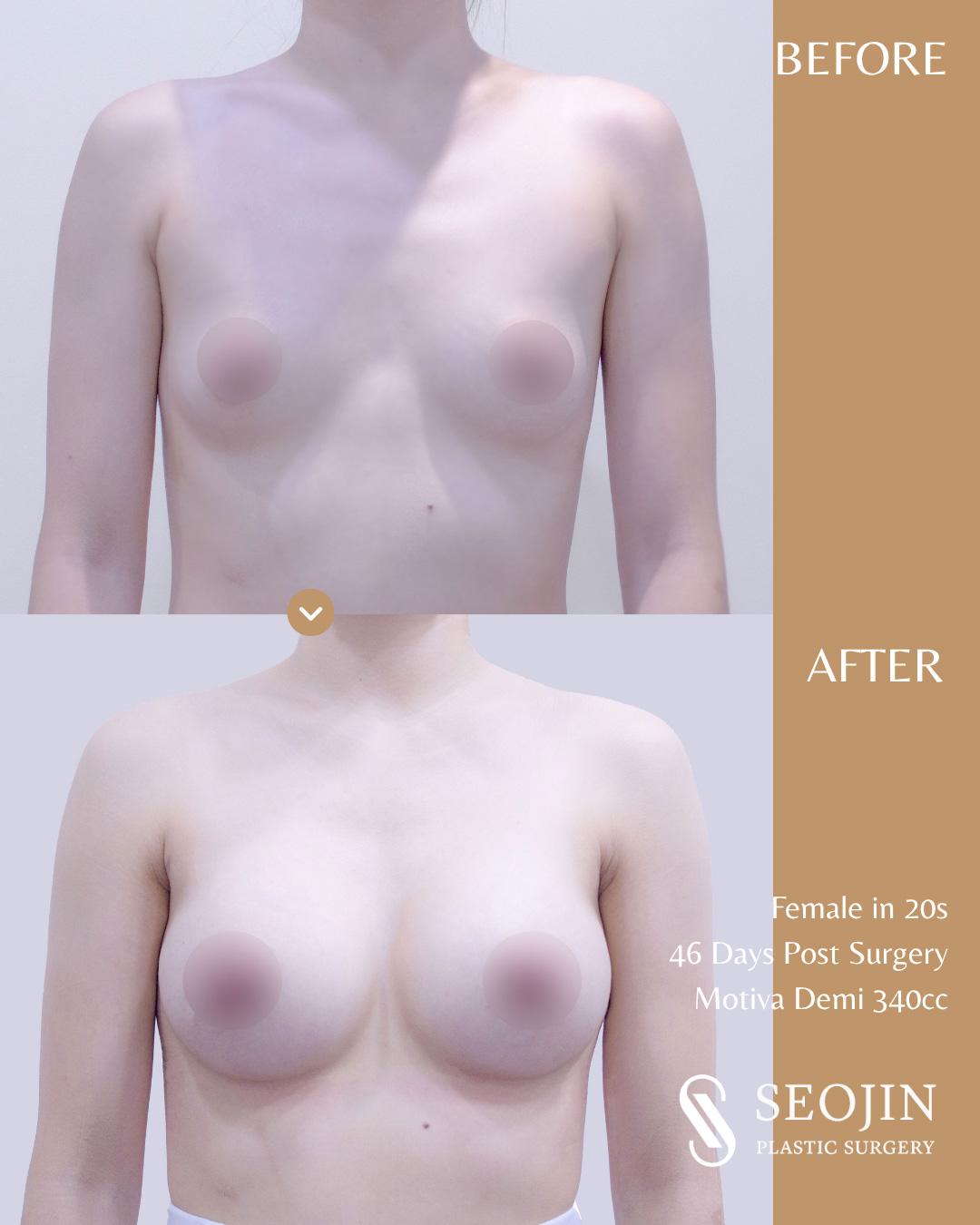 seojin-breast-implant-14 