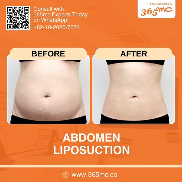 Real people, real results. Our models showcase the genuine outcomes of trusting 365mc for their body sculpting needs.