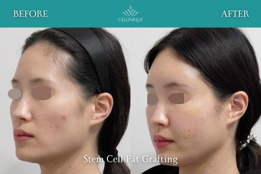 Before and After Stem Cell Fat Grafting