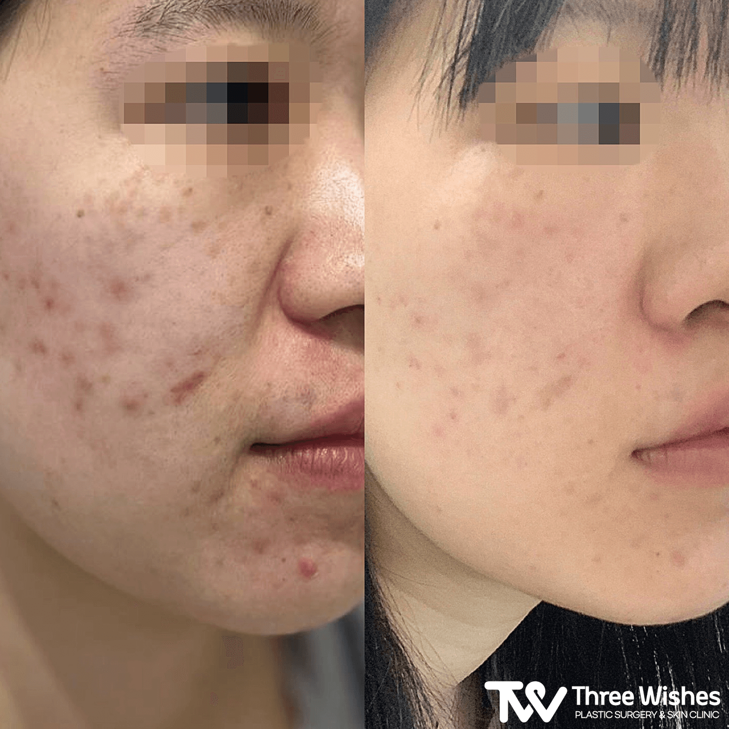 Three Wishes Clinic - Myeongdong before and after image