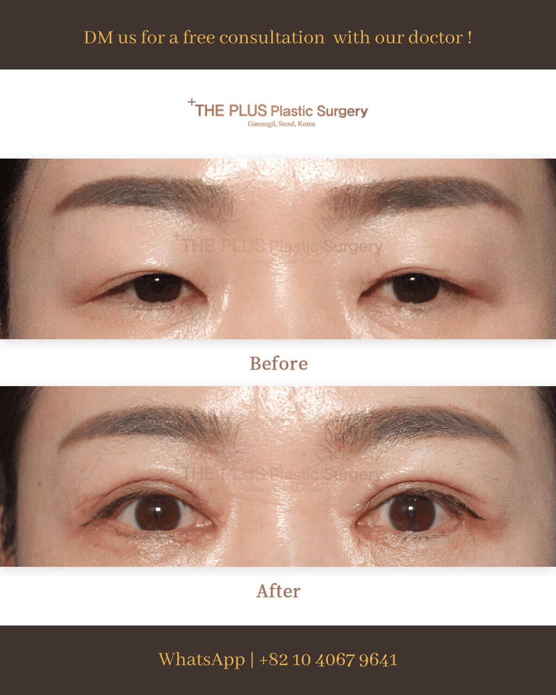 Revision Eye Surgery, Blepharoplasty, Canthoplasty
