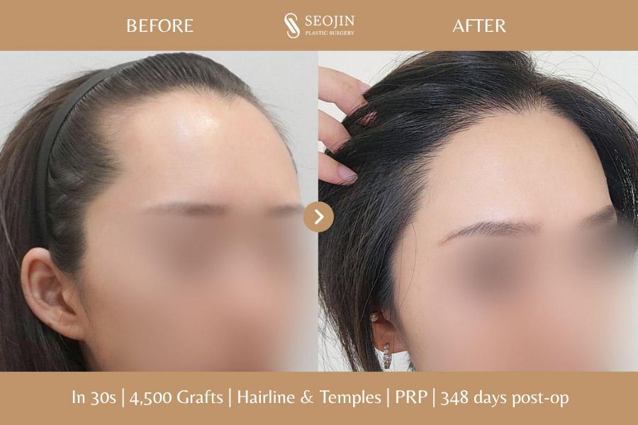 Before and After Hair Transplant