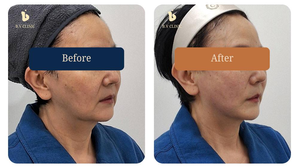 Before and After Face Thread Lift