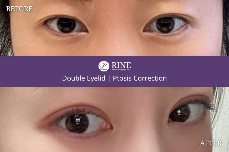 Double Eyelid ptosis correction