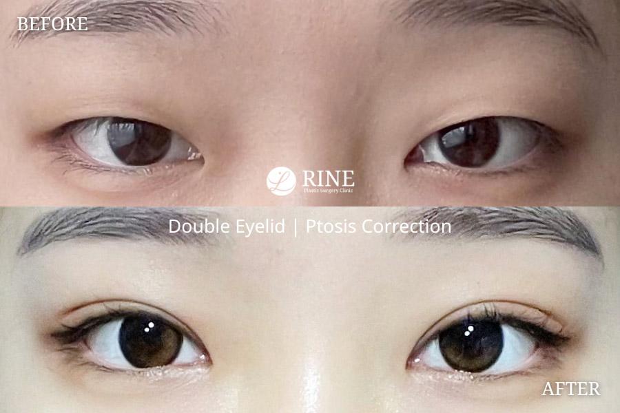 Before and After Double Eyelid Surgery
