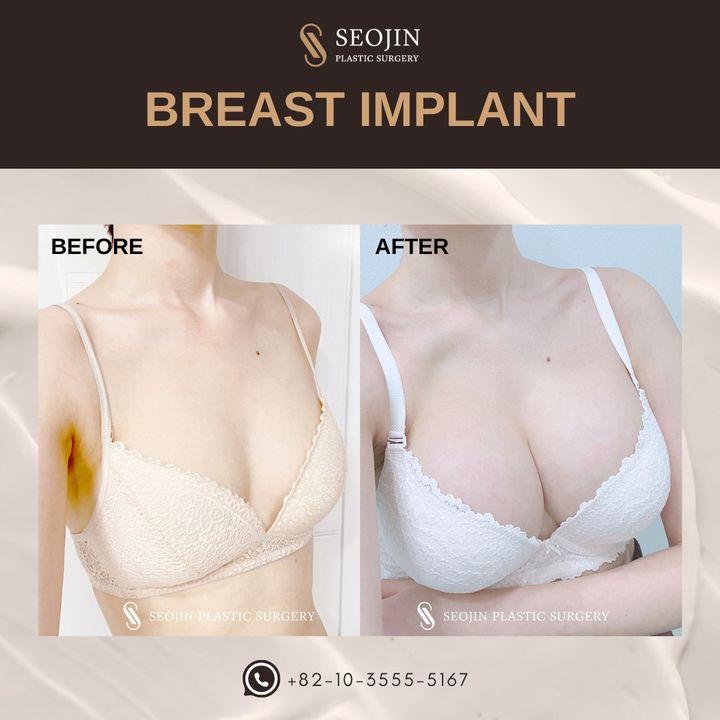 cost breast implant korea