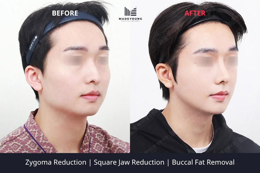 Reduction square jaw reduction buccal fat removal 1