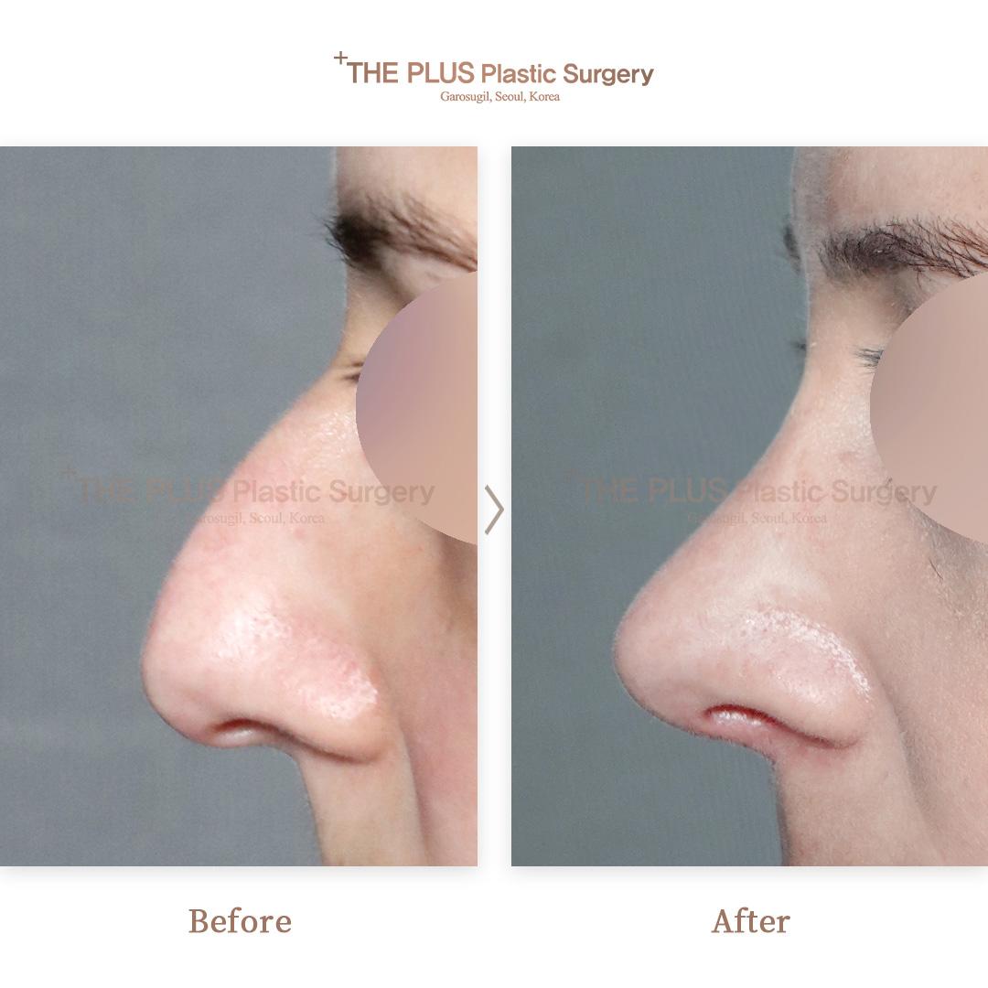 Primary Rhinoplasty & Hump Correction & No Silicone & Rib Cartilage & Nasal Septum Deviation & Nasal Septum Correction & Rhinitis