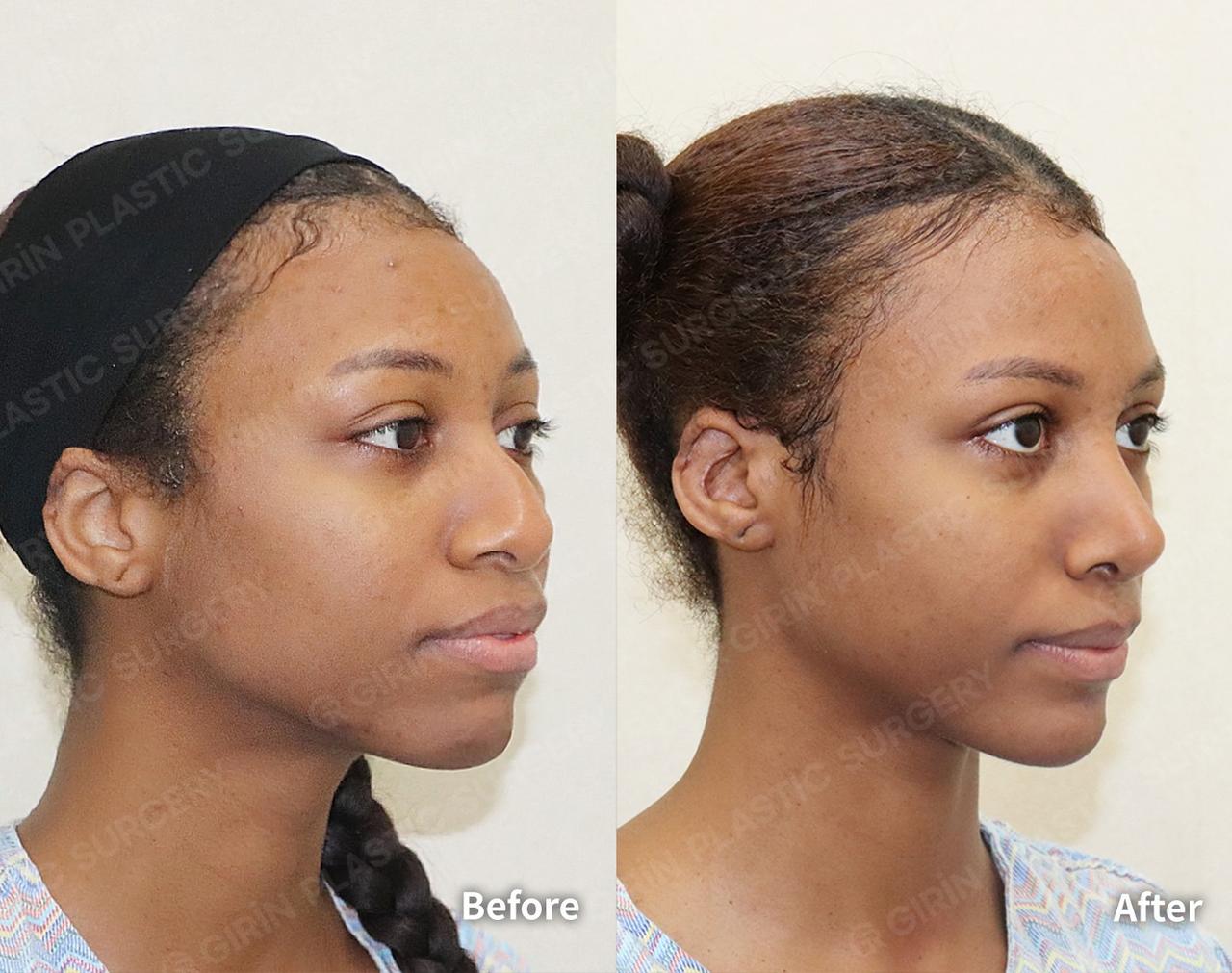 Before and After Rhinoplasty