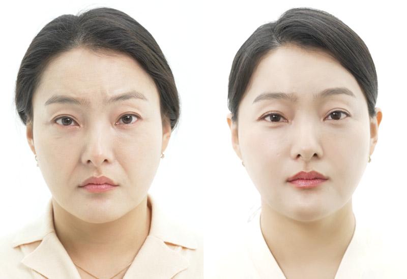 Before and After Face Thread Lift