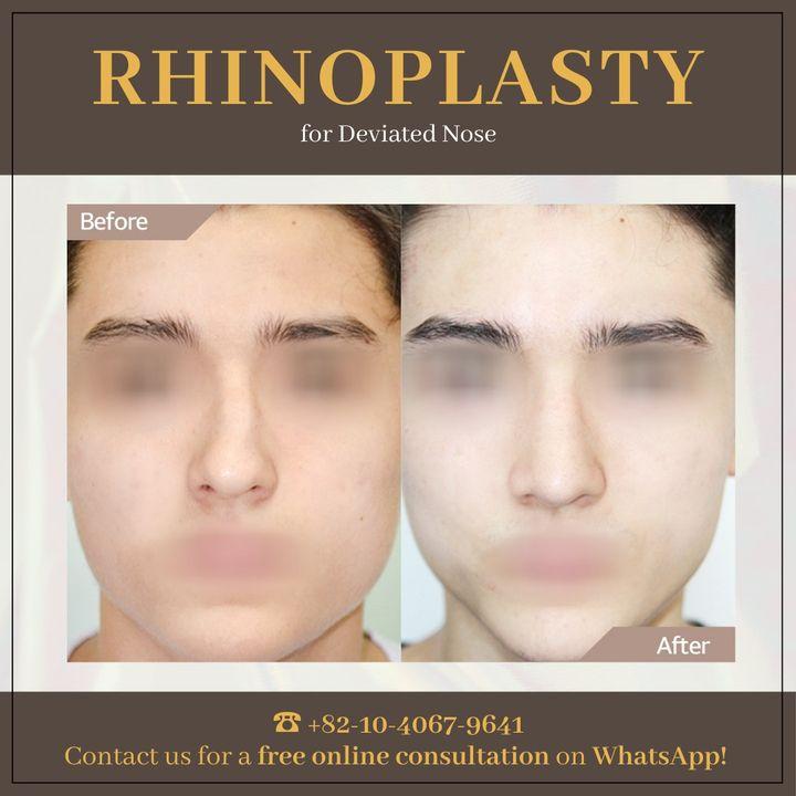Sehen Sie die eindrucksvollen Vorher-Nachher-Ergebnisse unserer Rhinoplastik.