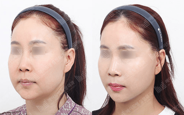 Before and After Face Lift