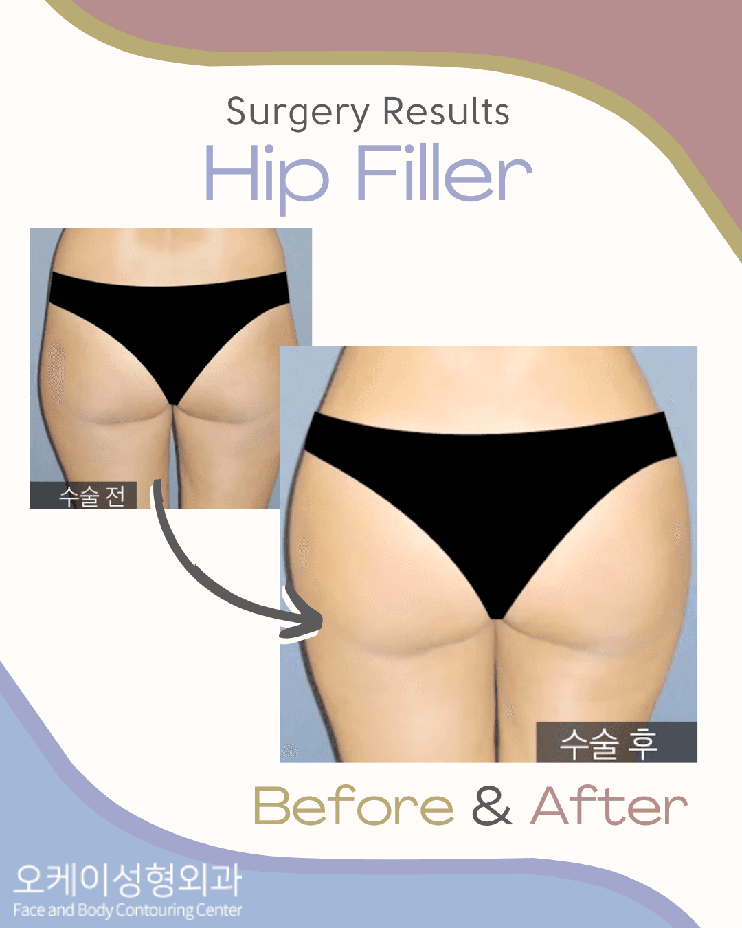 Vorher-Nachher-Bild der Okay Plastic Surgery Clinic