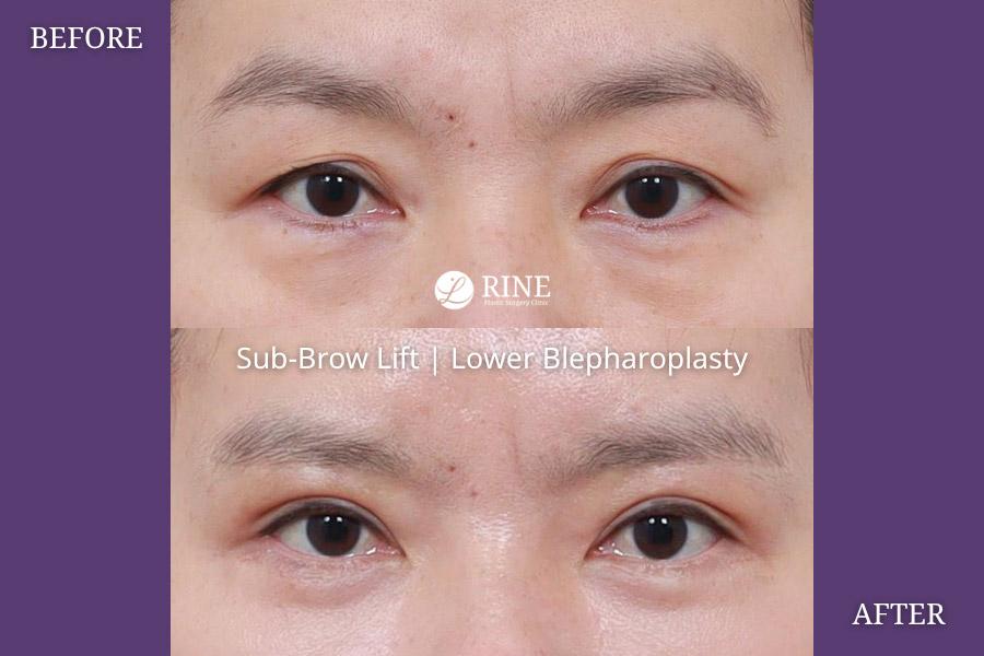 Sub Brow lift lower blepharoplasty