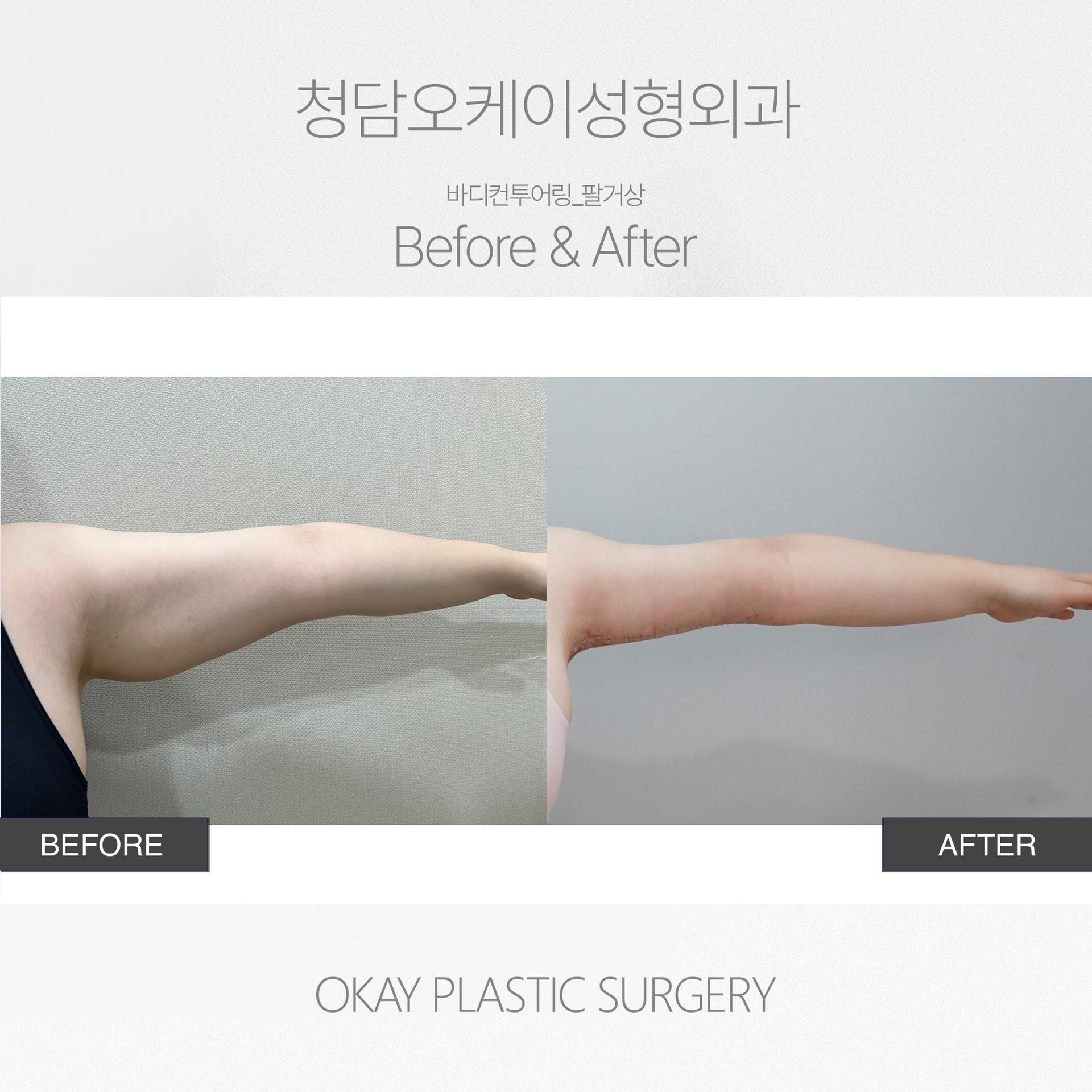 Okay Plastic Surgery Clinic before and after image